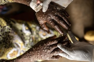 Au total, 42'000 cas de mpox ont été enregistrés en Afrique depuis janvier et quelque 1100 personnes sont mortes (archives). KEYSTONE/EPA/MICHAEL LUNANGA